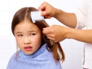 Head lice image 4