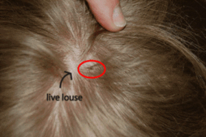 Head lice image 6